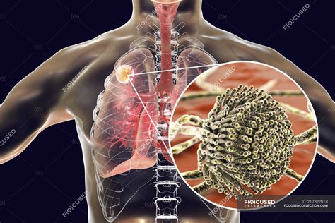 Aspergilloma of lungs and close-up of Aspergillus fungus, digital ...