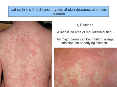 PPT - Different Types Of Skin Diseases And Their Causes PowerPoint ...