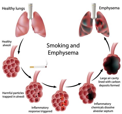 EMPHYSEMA - Google Search | MEDICINE | Pinterest | Science fair ...