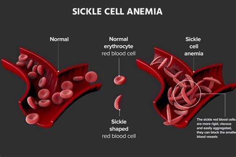 Sickle cell anemia: Causes, Symptoms & Treatment