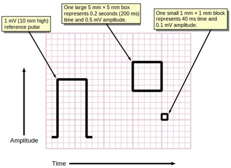 Introduction to ECG - wikidoc