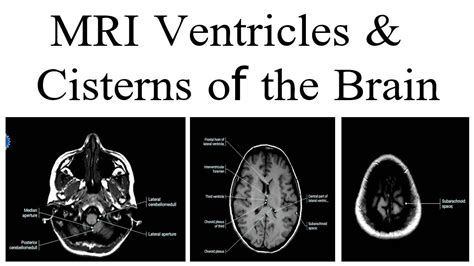 Enlarged Ventricles Brain Mri