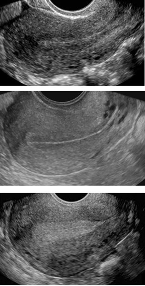 Endometrium changes with menstrual cycle. Sagittal ultrasound image of ...