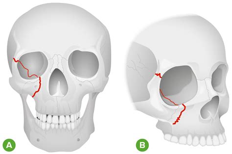 Orbital Fractures | Concise Medical Knowledge