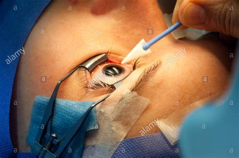 Types of Corrective Eye Surgery | Laser Eye Surgery