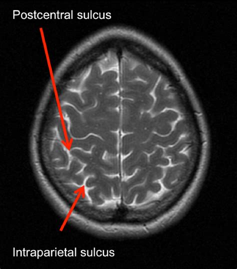 Postcentral Gyrus Mri