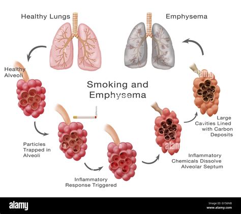 How Does Emphysema Affect Your Lungs - PELAJARAN