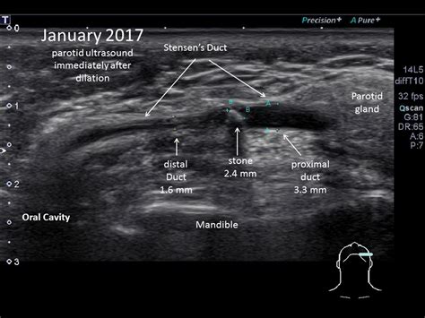 Parotid Gland Duct Ultrasound