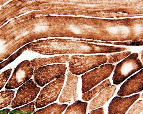 Central core disease: Cytochrome oxidase staining