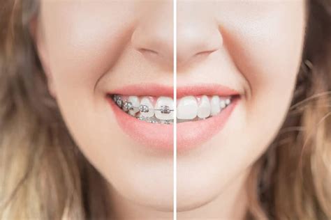 Before and After Braces | Orthodontic Services | Johns Creek GA