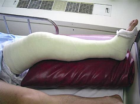 Cast Kit - Long Leg - Plaster - A-1 Medical Integration