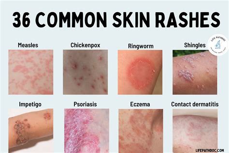 Rash: 36 Common Skin Rashes, Pictures, Causes & Treatment