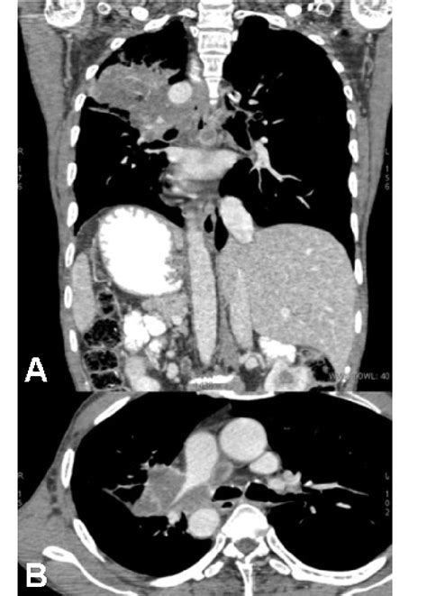 (A): Contrast CT of the thorax and abdomen: Image reveals the mass in ...