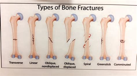 4 Types Of Bone Fractures