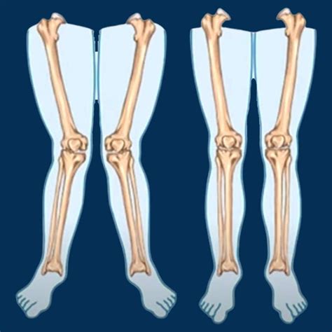 Knock Knee: Causes, Symptoms, Diagnosis and Treatment