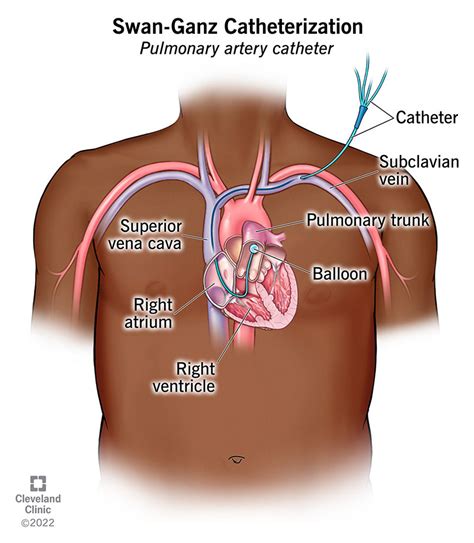 Swan-Ganz Catheterization