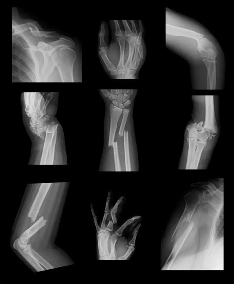 Common Types of Bone Fractures