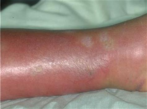 Erysipelas - Causes, Pictures, Treatment, Infection, Symptoms.