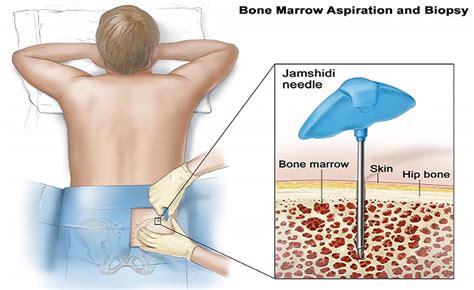 Bone Marrow Biopsy - Reasons, Pain, Complications