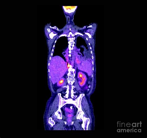 Pet - Ct Scan Of Lung Cancer Photograph by Living Art Enterprises, LLC