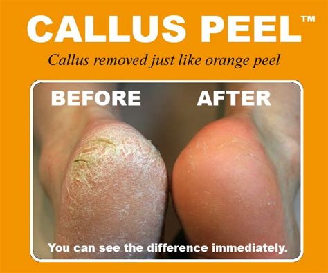 Callus formation is an accumulation of dead skin cells that harden and ...