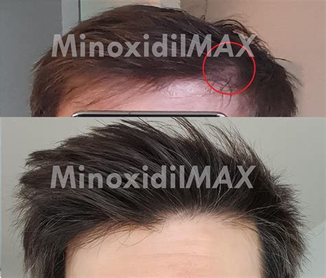 Minoxidil Before And After