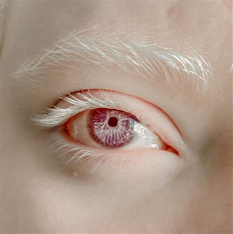 Pink and purple iris with white eyelashes and eyebrows Albino Red Eyes ...