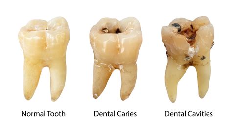 Dentist Showing A Cavity With A Mouth Mirror - HooDoo Wallpaper