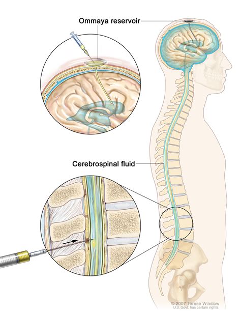 Intrathecal chemotherapy. Causes, symptoms, treatment Intrathecal ...