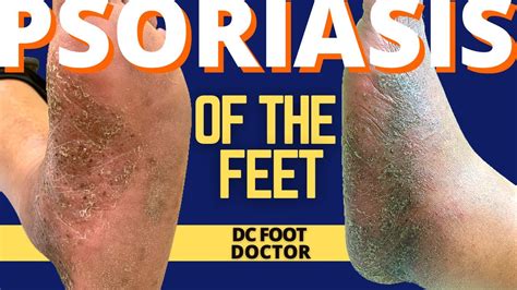 Psoriasis and the Feet, Part 2: Treating Pustular Psoriasis of the Skin ...