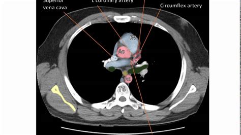 Anatomy of a Transverse CT of the Thorax - YouTube