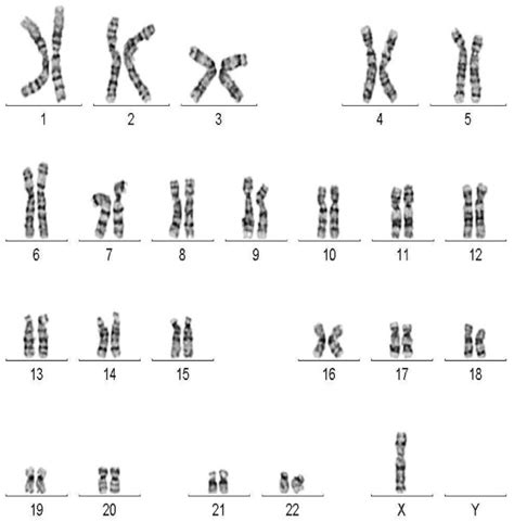 Neocentric X-chromosome in a girl with Turner-like syndrome (PDF ...