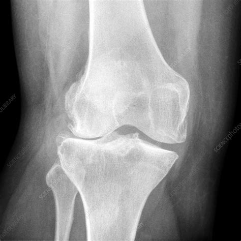 Knee in osteoarthritis, X-ray - Stock Image - C030/2153 - Science Photo ...