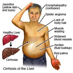 Liver Cirrhosis Symptoms Skin