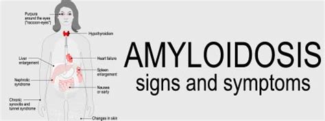 Amyloidosis: Causes, Symptoms And Treatment