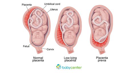 Placenta previa symptoms, possible complications, and risk factors ...