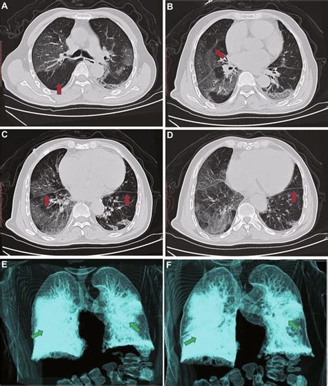 How coronavirus enters lungs, affects breathing | Nigerian News, Latest ...