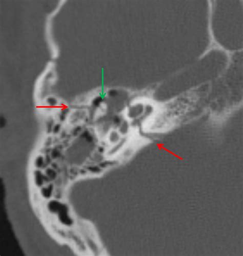 CaseStacks.com - Neuroradiology CT Case #30