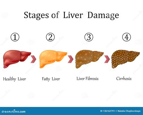 Liver Cirrhosis Stages