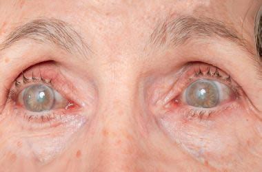 Diabetic Retinopathy and Diabetes-Related Eye Problems