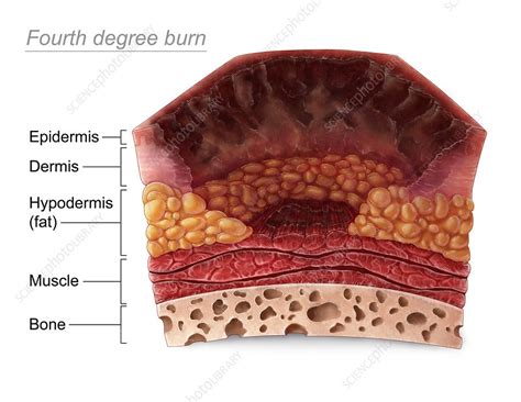 Fourth Degree Burn - Stock Image - C030/5968 - Science Photo Library