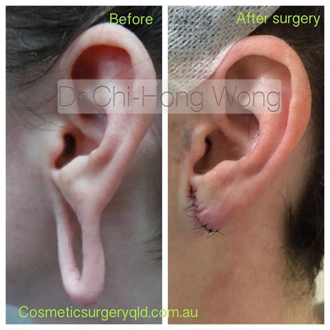 Ear Lobe Repair Surgery in Brisbane very experienced doctor