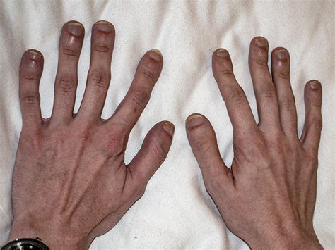 Clubbed fingers: Causes, symptoms, treatment, and when to seek help