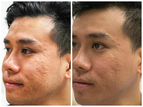 Acne Scar Treatment: CO2 Laser + TCA Results after 5 Sessions