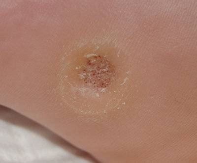 Plantar Warts: Symptoms, Causes, and Treatment Options