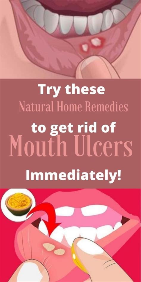 12 Natural Remedies for Mouth Sores that Work - NaturalRelieved