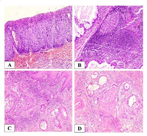 Histology of Cervical Lesions after Routine Hematoxylin and Eosin ...