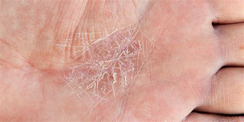 6 Eczema Symptoms You Should Bring Up With Your Derm | SELF