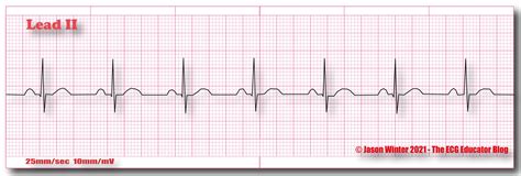 ECG Educator Blog : Normal Sinus Rhythm