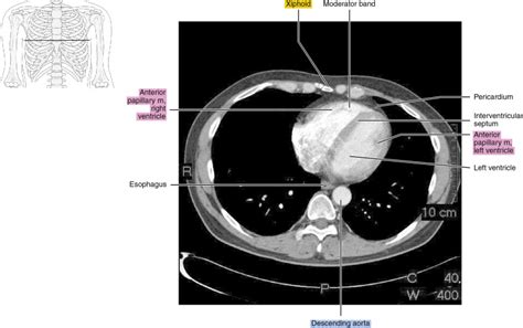 CT of the thorax | Radiology Key